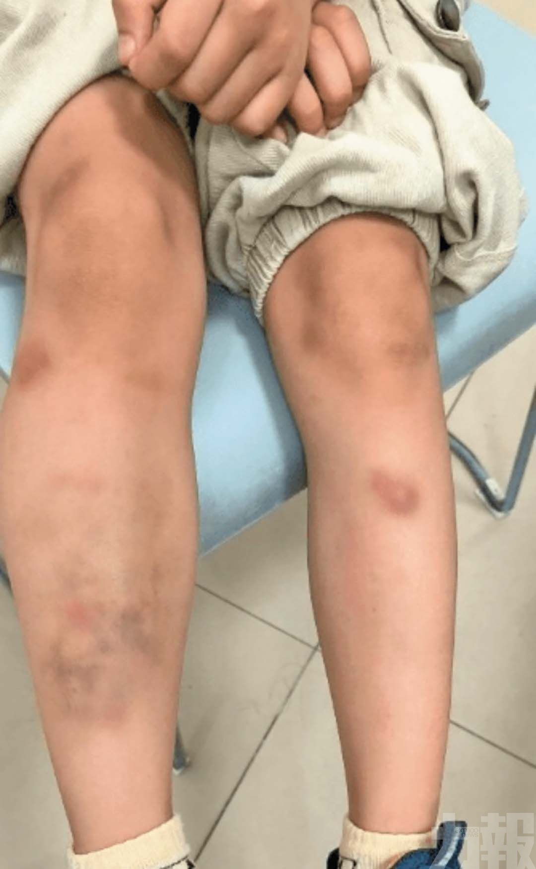 6歲童食生菜包烤肉滿身瘀斑