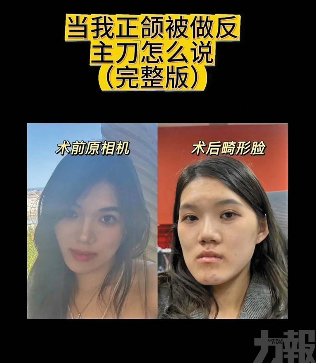 女接受正頜手術變「朱元璋」