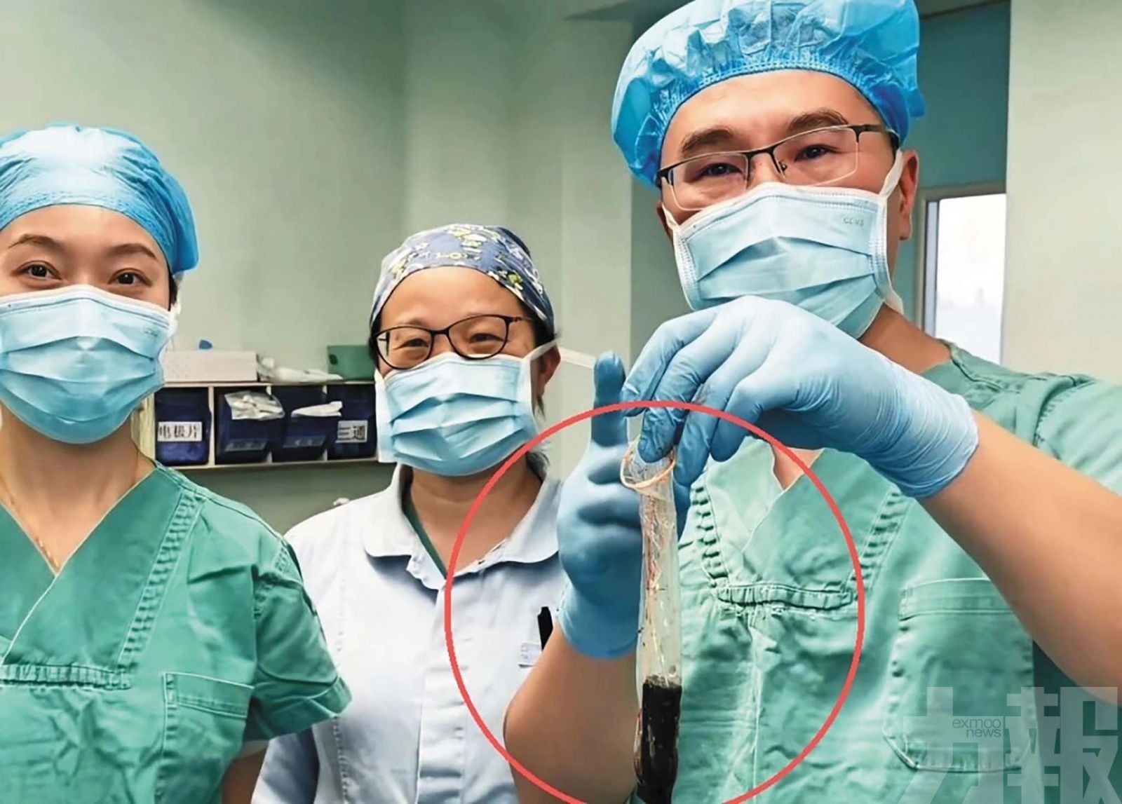 男腹痛就醫驚見「 30年前吞下的打火機」