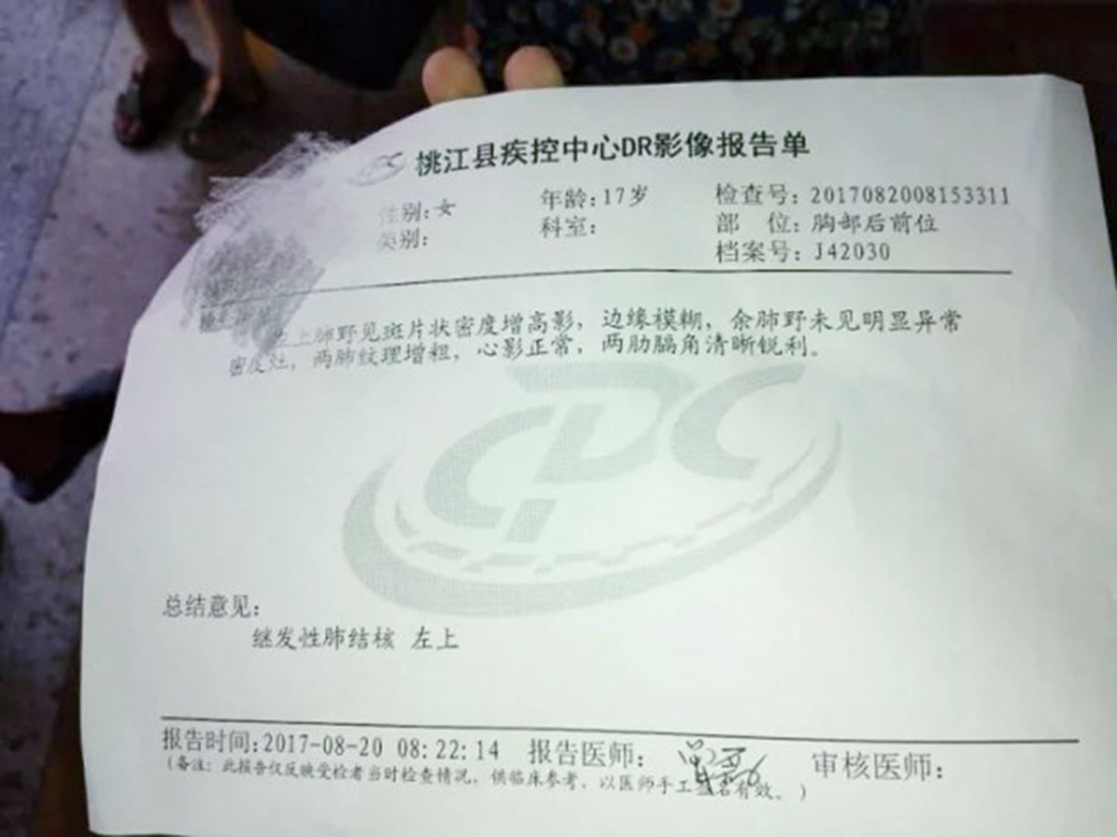 湖南名校生集體患肺癆