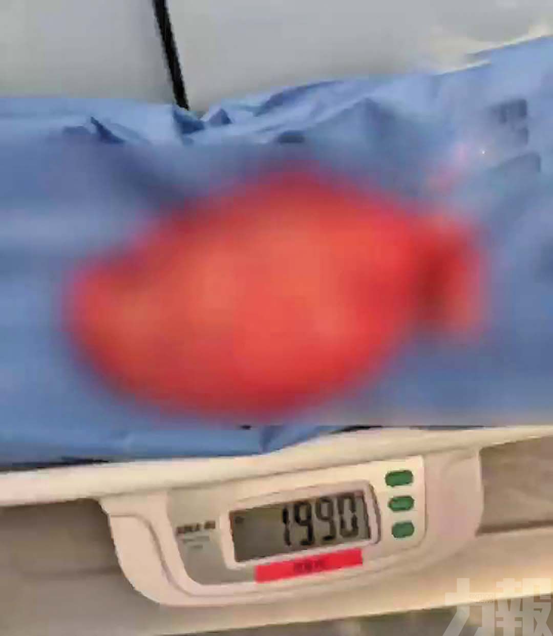 湖南16歲少女腹脹如懷胎八月
