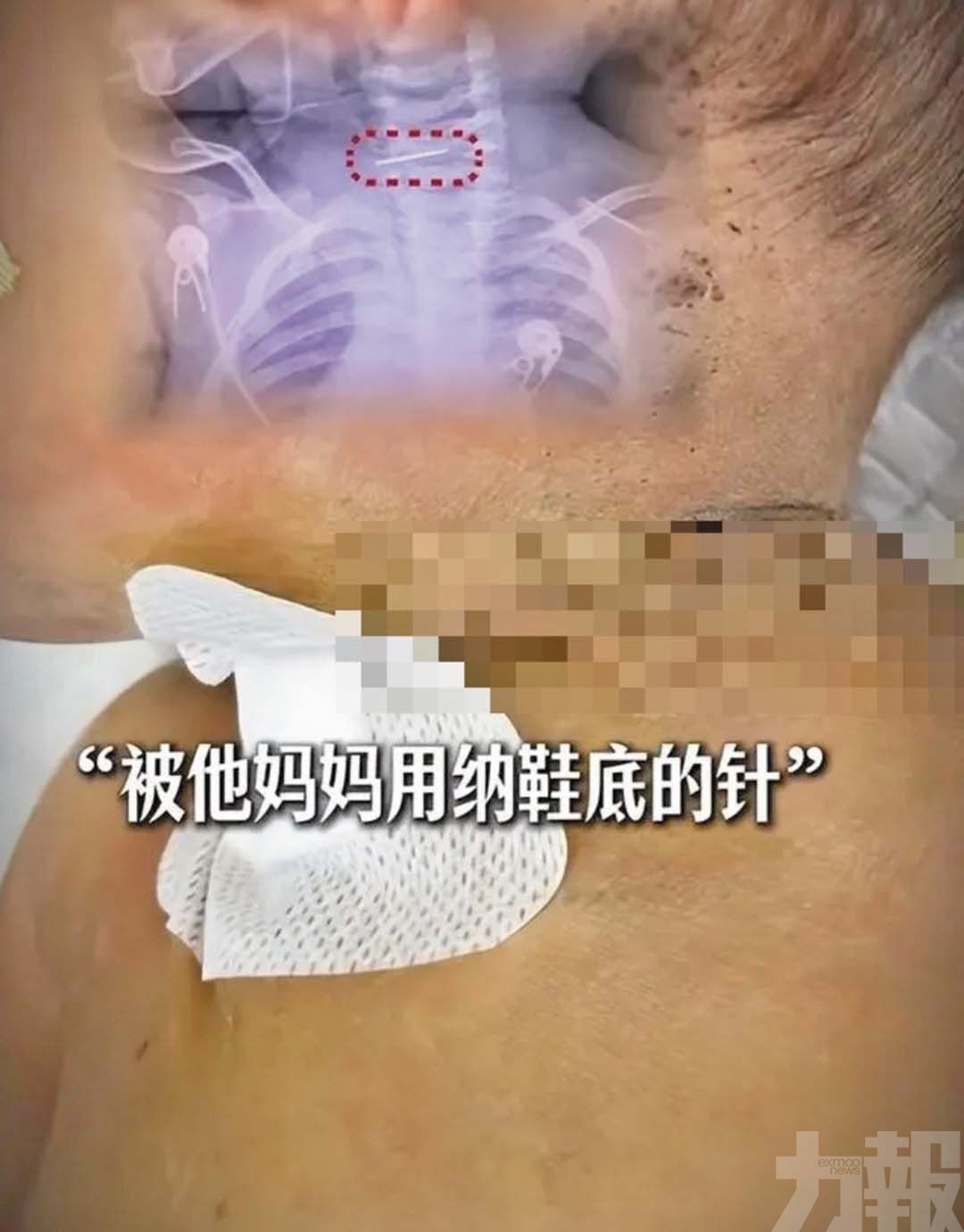 雲南10月大男嬰遭母親針扎數百孔