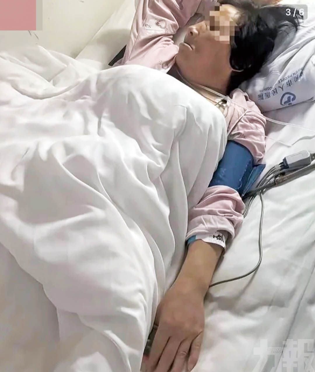 山西婦一次被拔12顆牙心梗休克